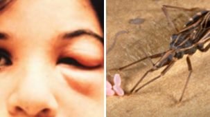 հիվանդությունը Chagas